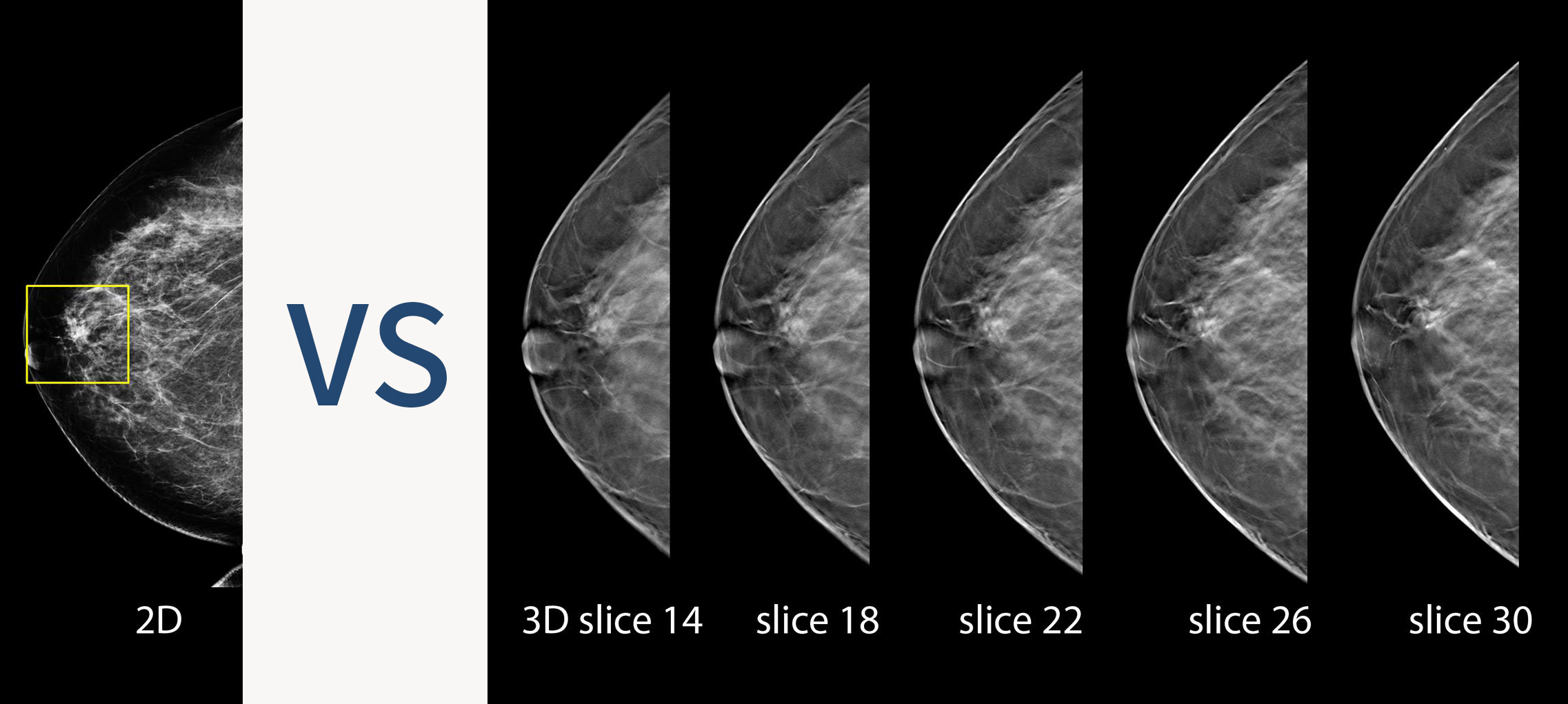 Breast Tomosynthesis 3D Mammography Centres And Services St Paul breast-tomosynthesis-3d-mammography-centres-and-services-st-paul